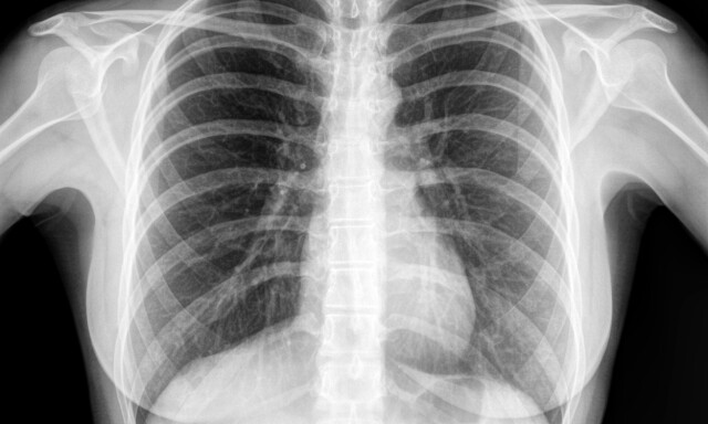 RØNTGEN THORAX: Man tar røntgenbildet av brystet rutinemessig før oppstart med biologisk behandling. Dette er blant annet for å utelukke infeksjon med tuberkulosebakterien. FOTO: NTB Scanpix / Shutterstock / pisaphotography RØNTGEN THORAX: Man tar røntgenbildet av brystet rutinemessig før oppstart med biologisk behandling. Dette er blant annet for å utelukke infeksjon med tuberkulosebakterien. FOTO: NTB Scanpix / Shutterstock / pisaphotography